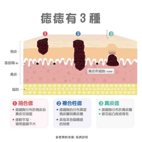 三星痣長怎樣|痣形成的原因？痣長毛、痣變多變大是痣病變？5招判。